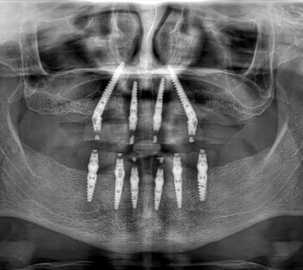 Транс Синусови зъбни импланти