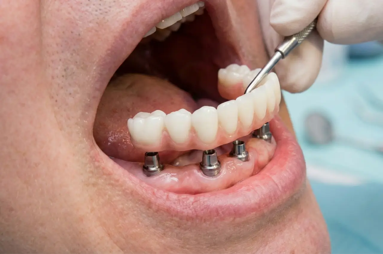 All on 4 Dental Implants