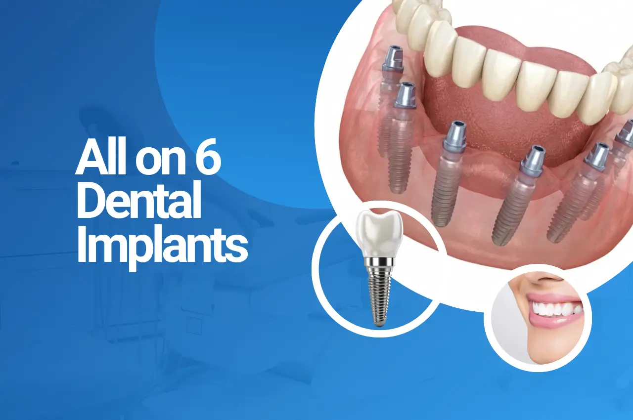 All on 6 Dental Implants