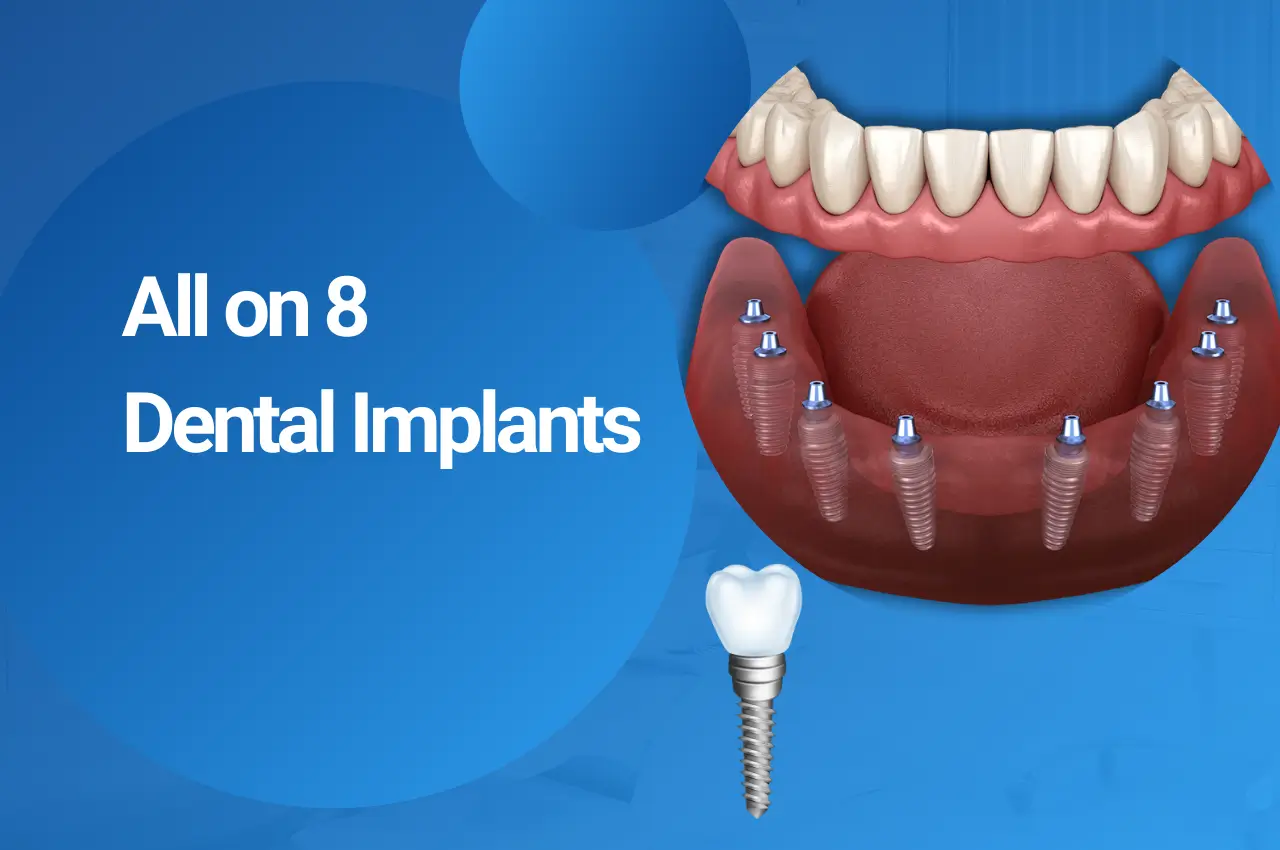 All on 8 Dental Implants