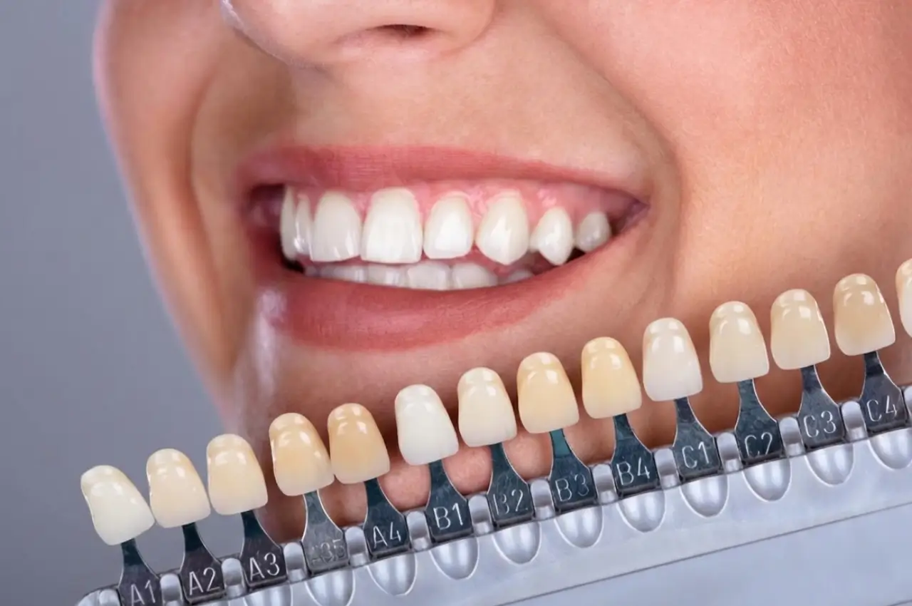 Dental Veneers