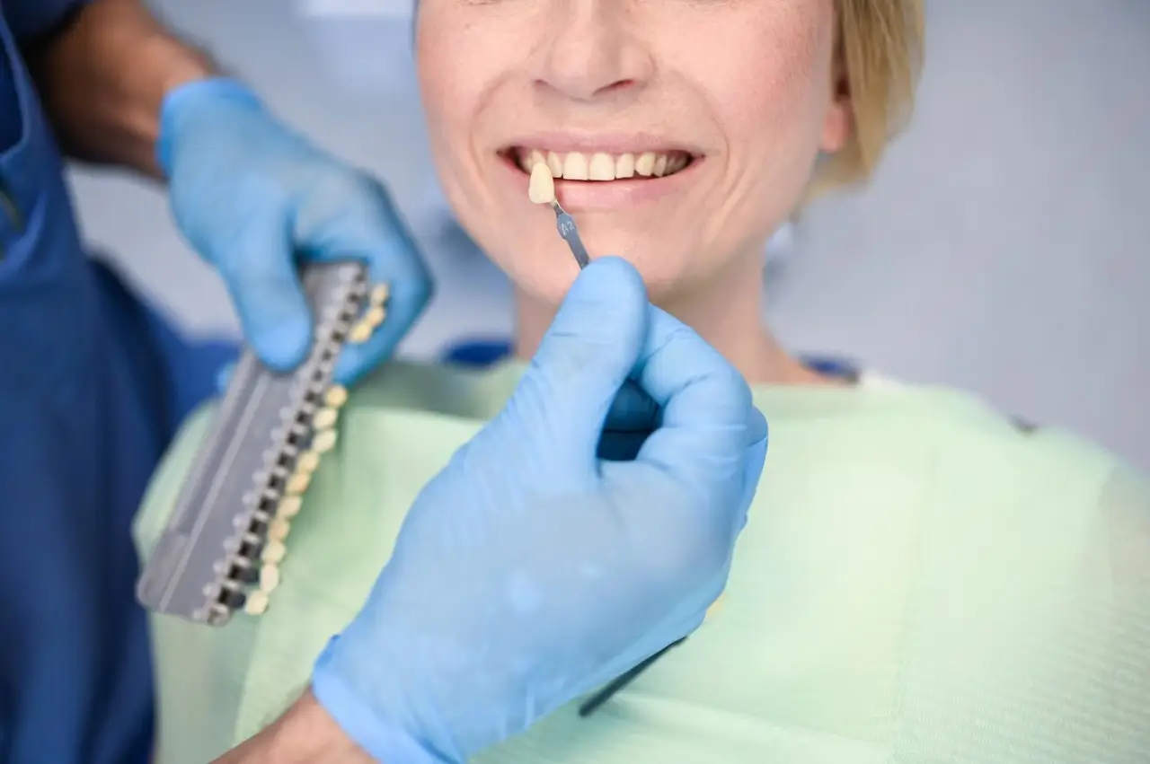 E-max Veneers
