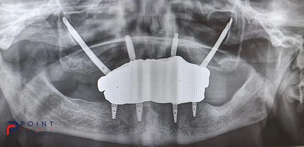 Final panoramic X-ray showing a full-mouth fixed dental prosthesis supported by zygomatic, nasal, and conventional implants.