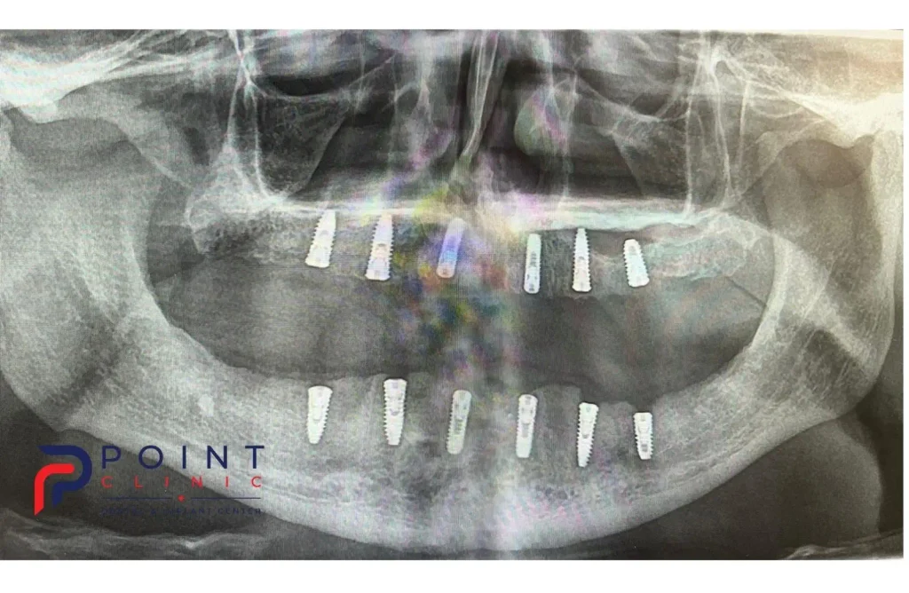 Confident post-operative smile showing the natural look of a completed full-mouth restoration with bar-supported zirconia teeth.