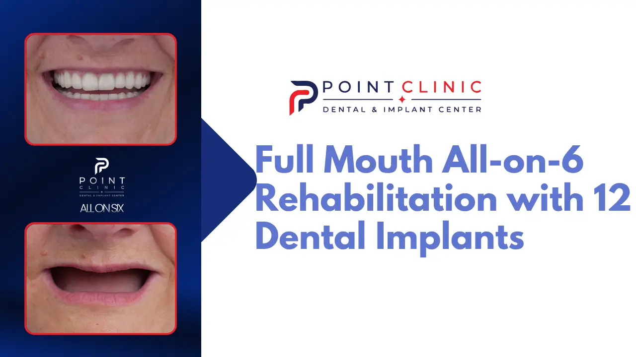 Full-Mouth All-on-6 Rehabilitation with 12 Dental Implants