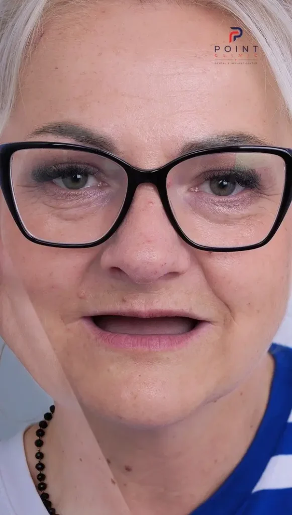 Joanna’s journey from long-term tooth loss to a fixed full-mouth All-on-6 rehabilitation with 12 dental implants