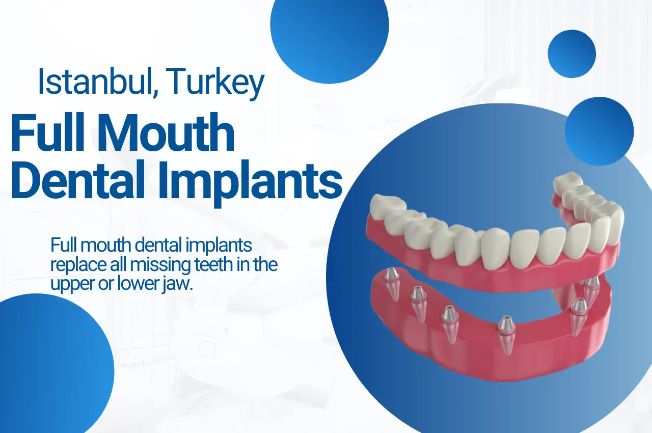 Пълни зъбни импланти