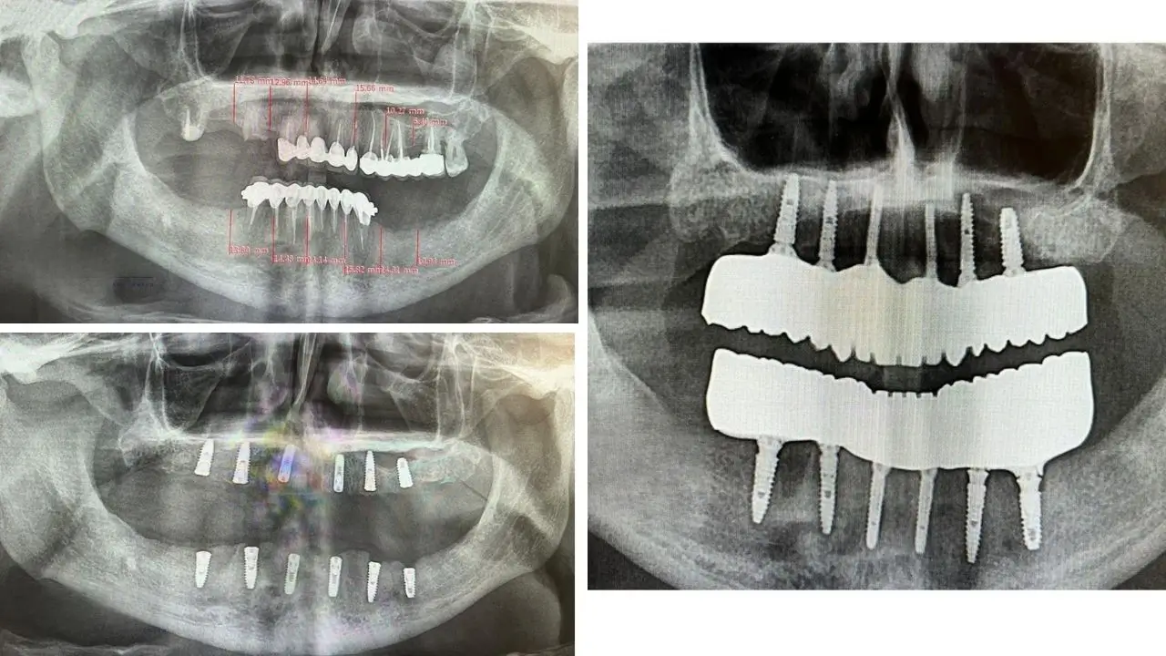 Titanium Bar-Supported Zirconia: A Real 12-Implant All-on-6 Case Study