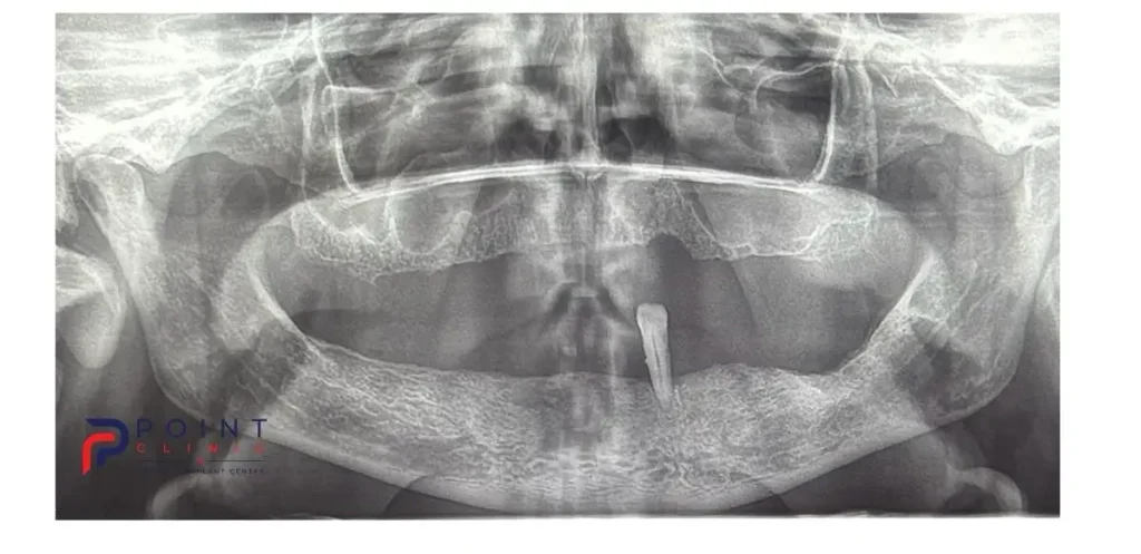 Pre-operative panoramic dental X-ray showing severe upper jaw bone loss and one remaining lower tooth.