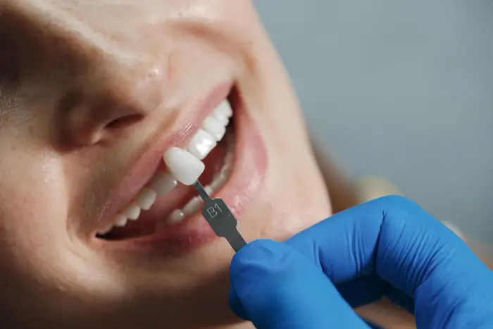 Licówki dentystyczne w Turcji