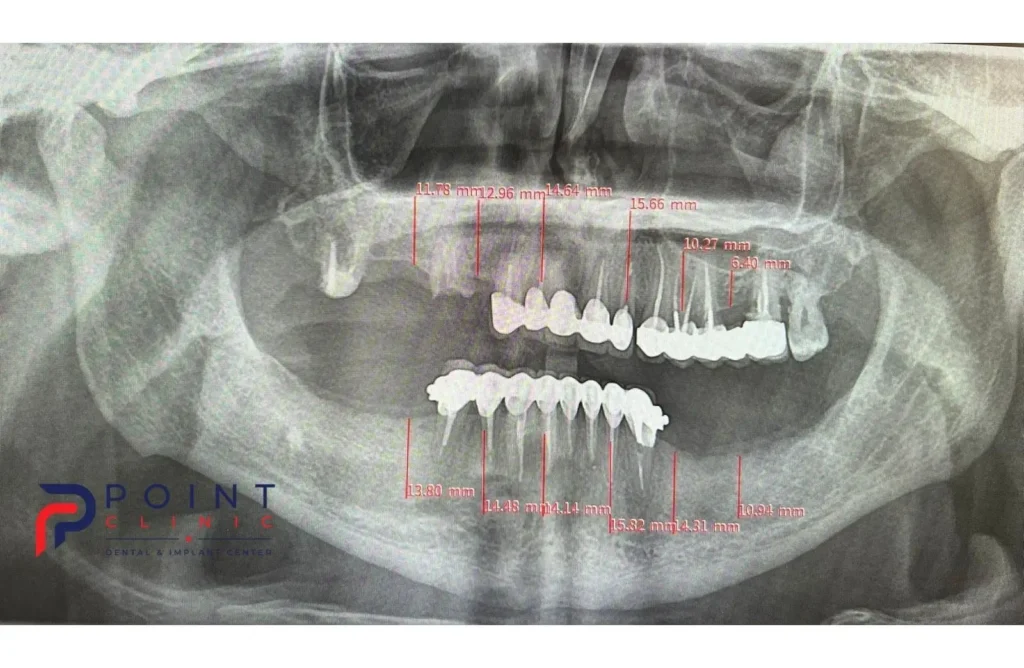 Pre-operative panoramic X-ray view of missing teeth and jawbone before dental implant surgery.