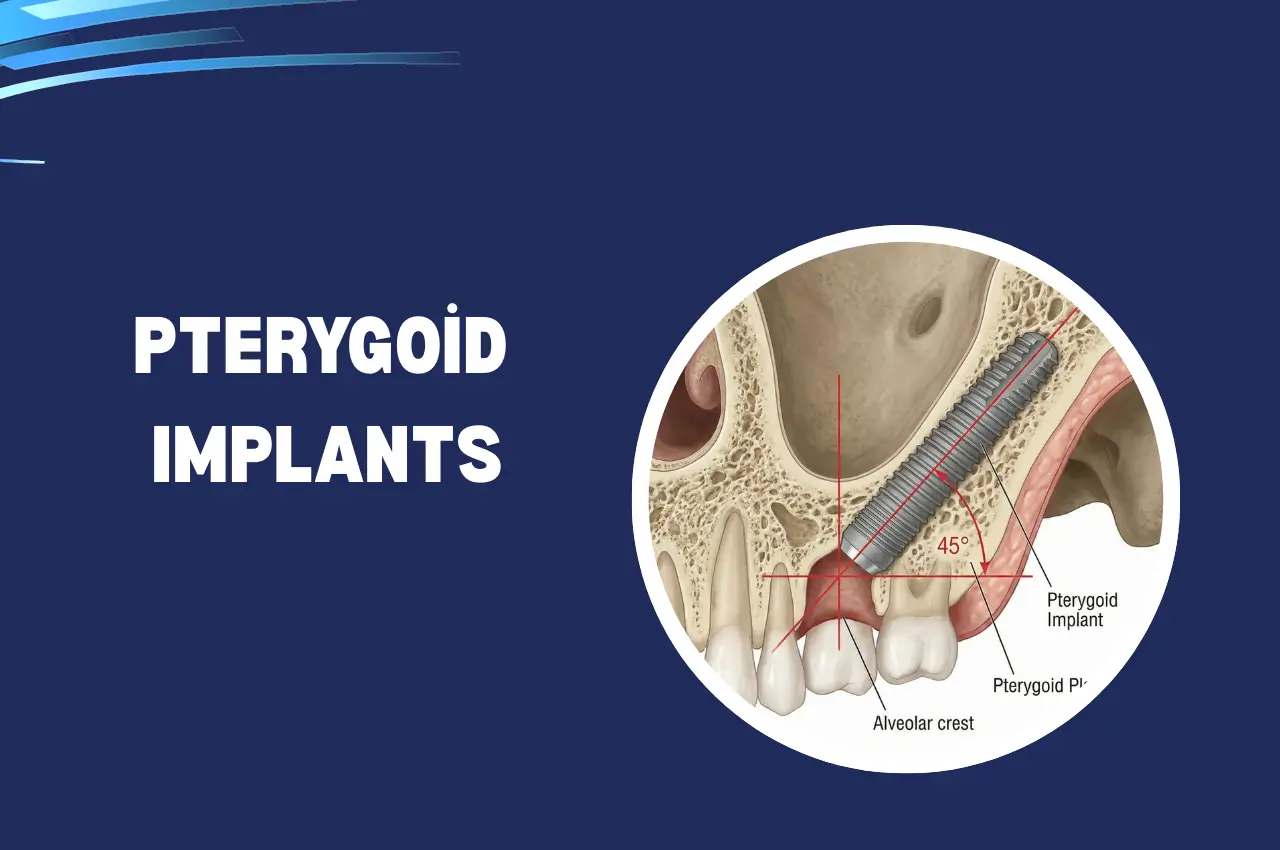 Pterygoid Implants