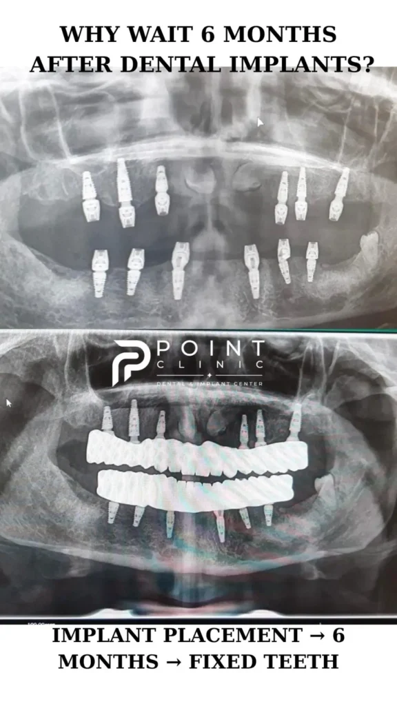 Real Case: 12 Neodent Dental Implants and a 6-Month Healing Period