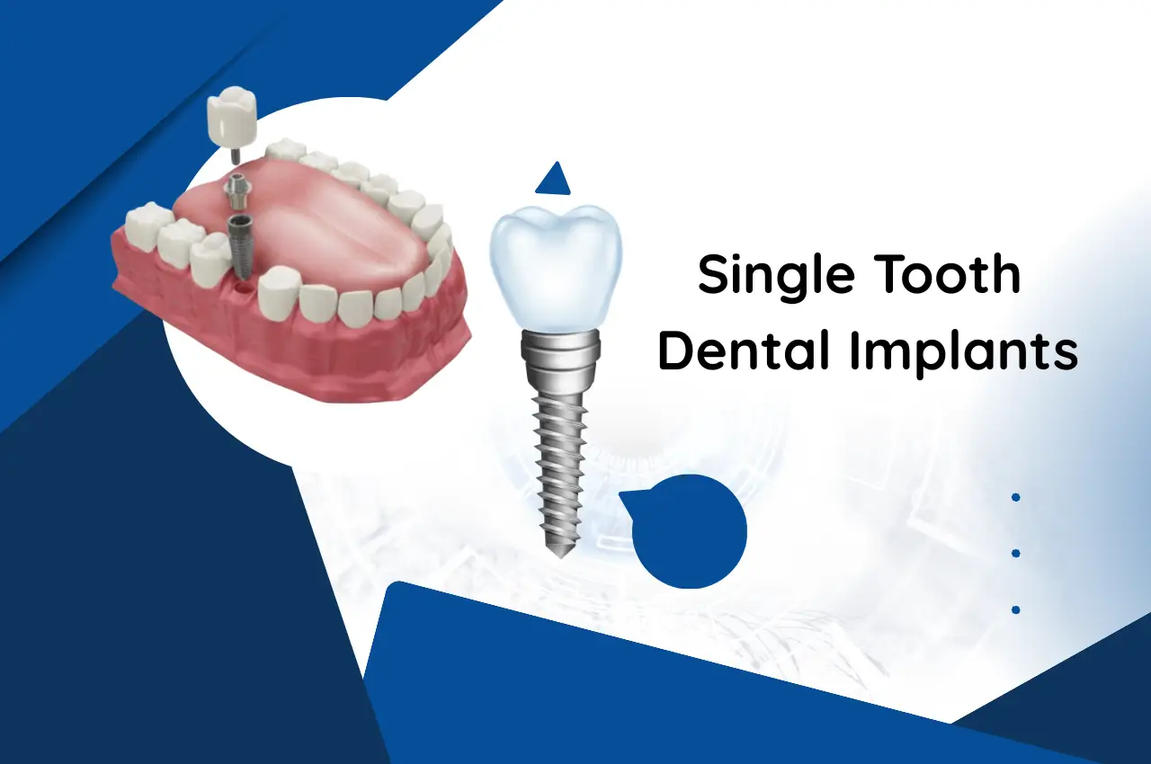 Single Tooth Dental Implants