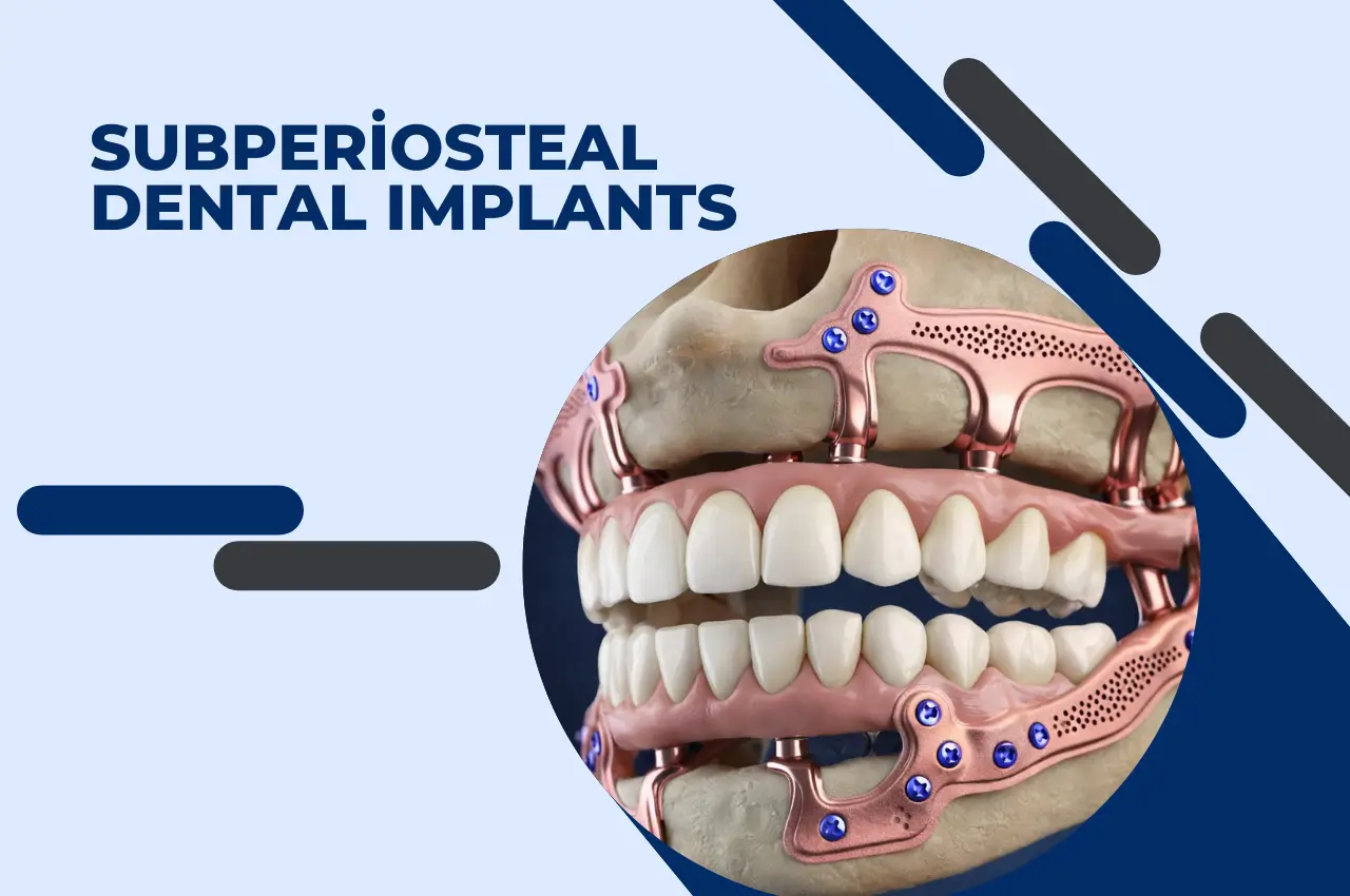 Subperiosteal Dental Implants 
