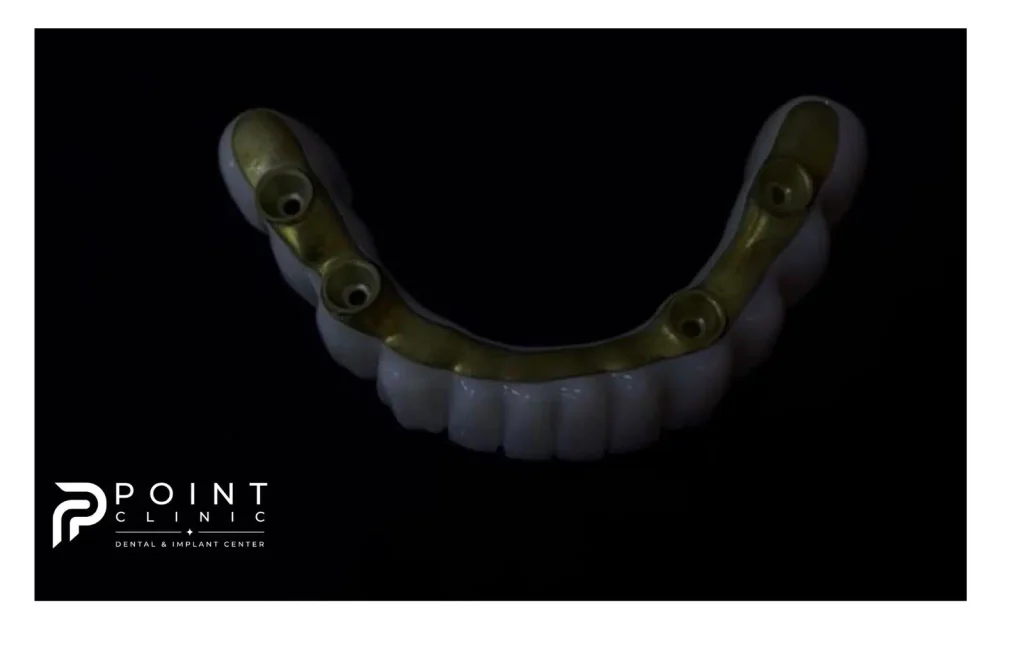 Close-up view of a custom-milled titanium bar framework secured onto dental implants in the maxilla (upper jaw).
