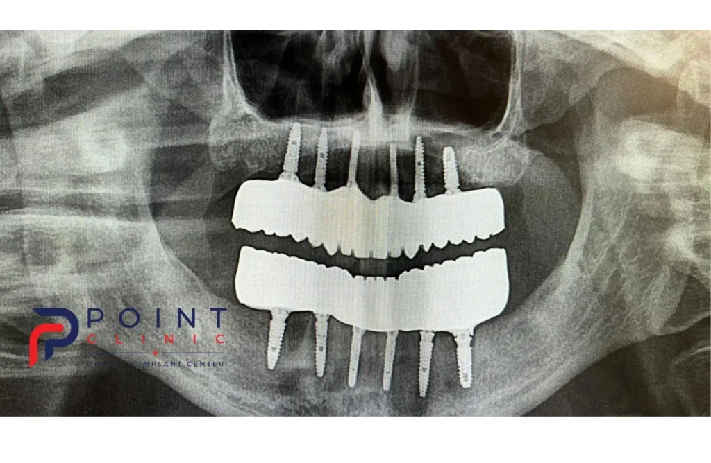 View of a full-arch zirconia prosthetic bridge resting over the supporting titanium bar framework before final cementation.