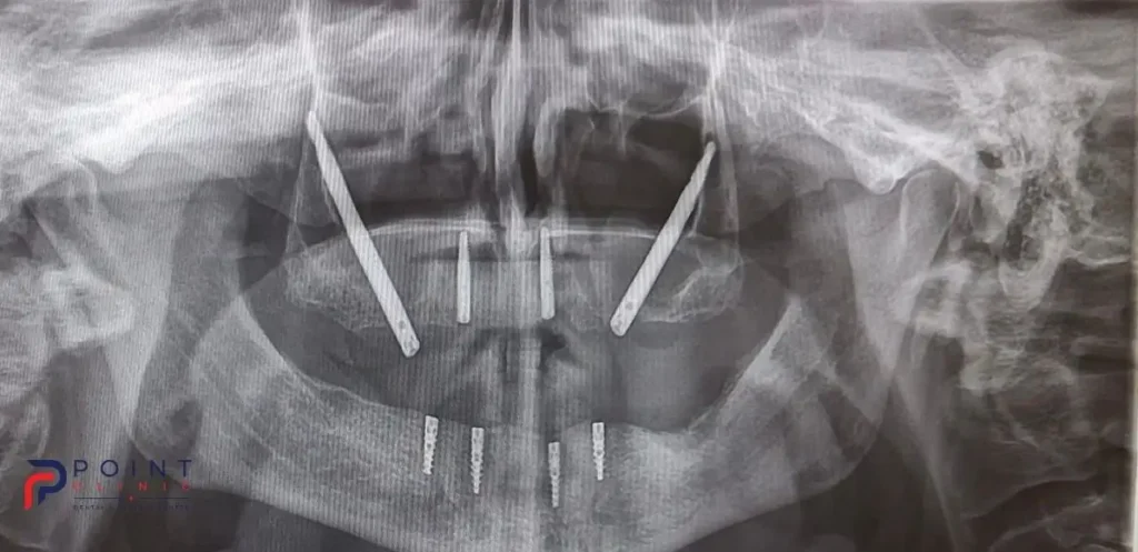 Post-operative panoramic X-ray showing two zygomatic implants, two nasal implants, and four conventional lower implants.