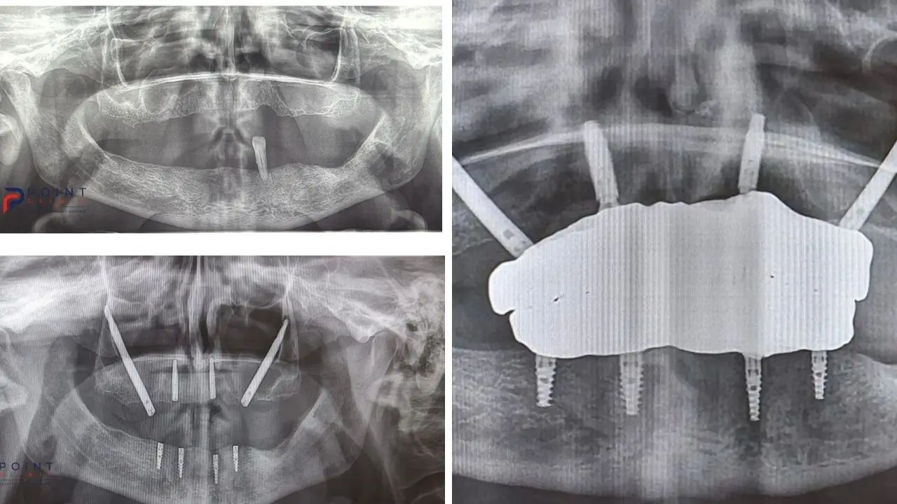 Can You Get Full-Mouth Dental Implants With Severe Bone Loss? From Removable Dentures to Fixed Teeth: A Real Patient Case from Poland