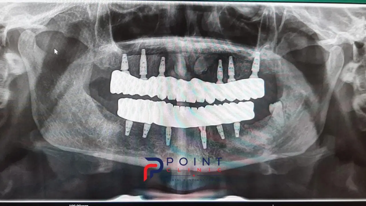 How Long Do Dental Implants Take to Heal? Understanding the 3–6 Month Osseointegration Period