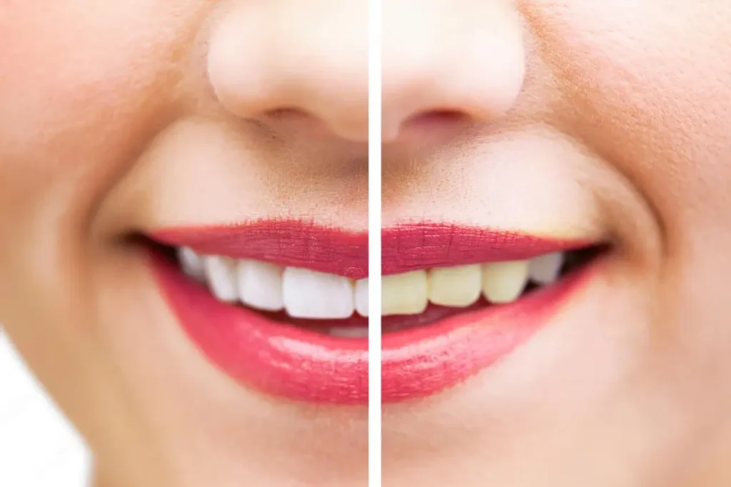dentist teeth whitening