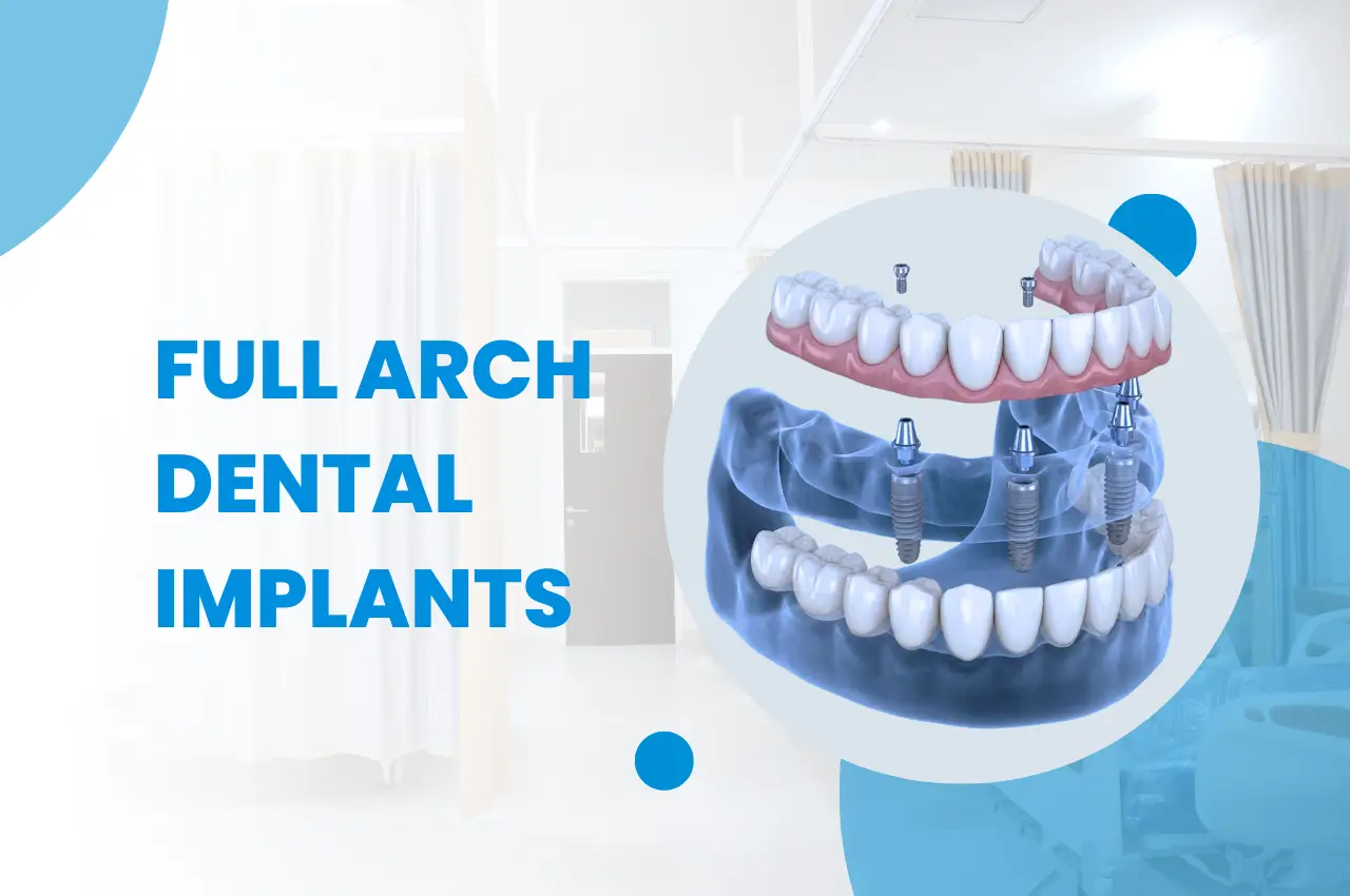 Full Arch Dental Implants