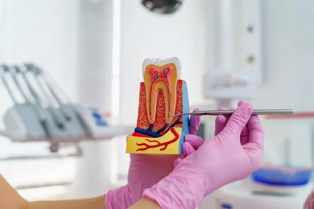 Root Canal