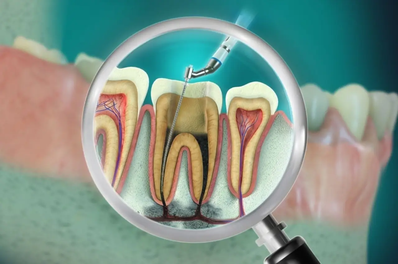 Root Canal Treatment