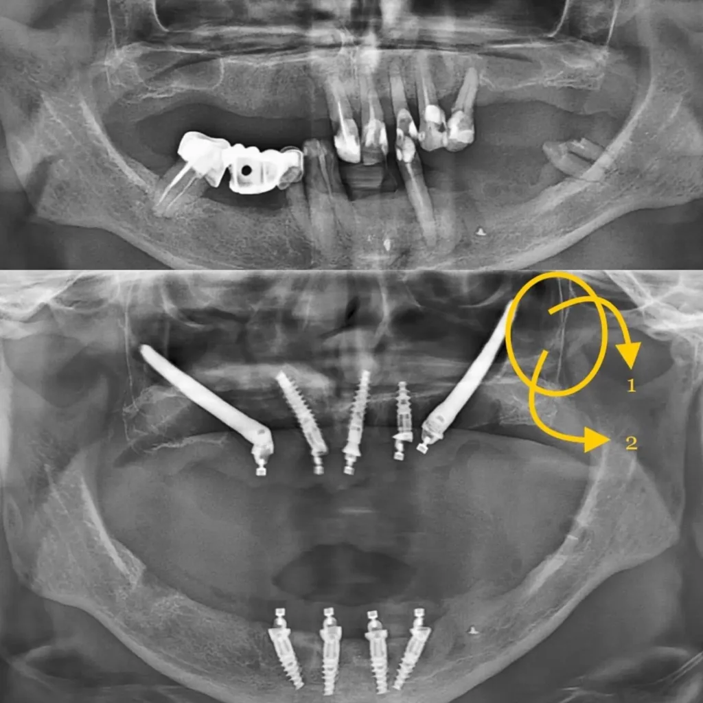 transnasal implants
